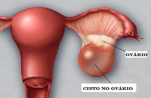 ovario 4